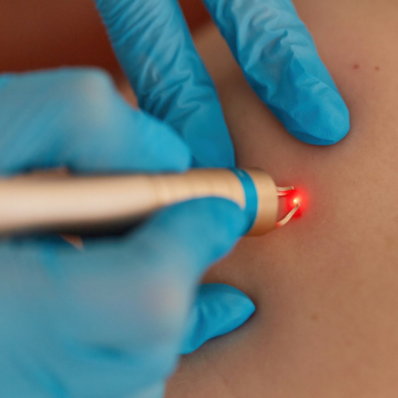 Session of laser therapy closeup view shot